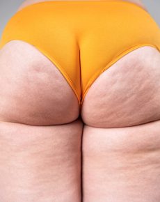 Lipedema Type 5: Characteristics, Symptoms & Treatment Options
