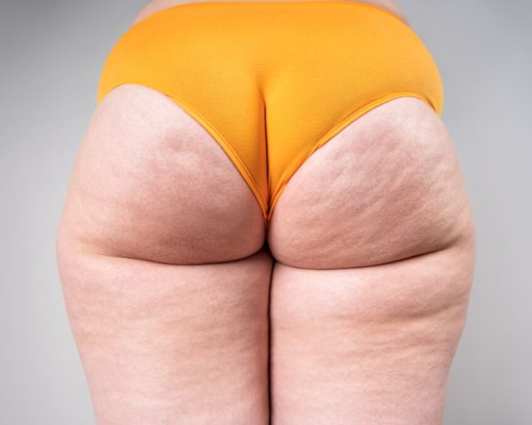 Lipedema Type 5: Characteristics, Symptoms & Treatment Options