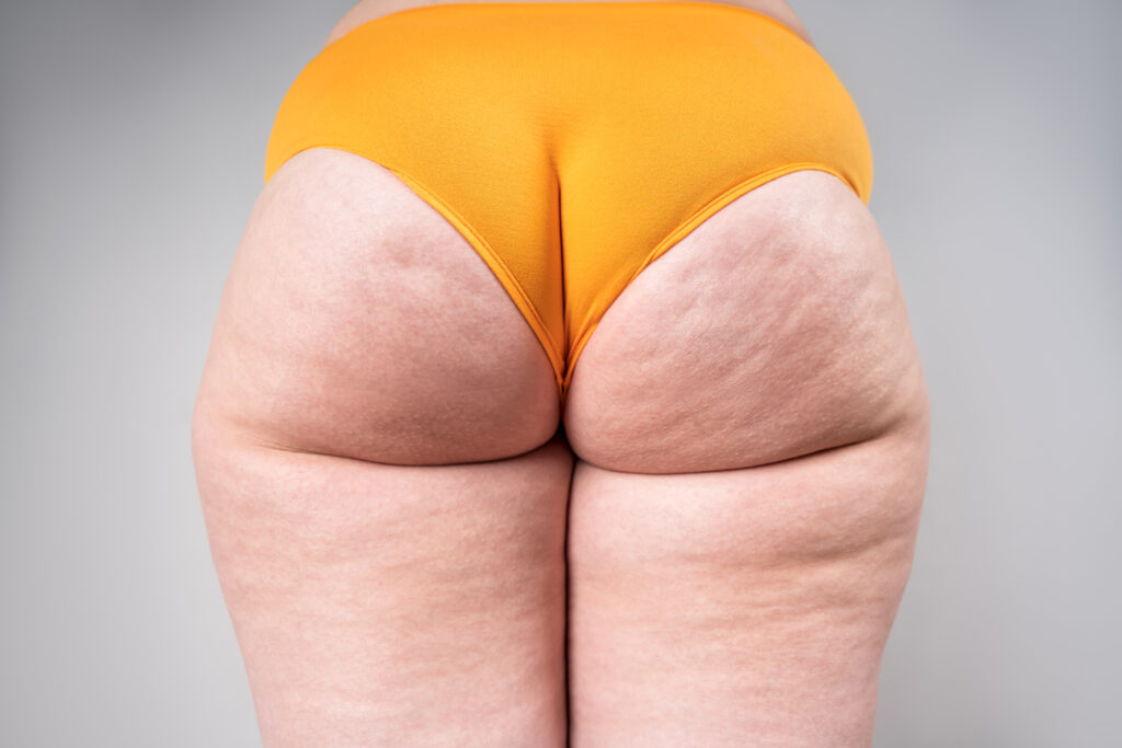 Lipedema Type 5: Characteristics, Symptoms & Treatment Options