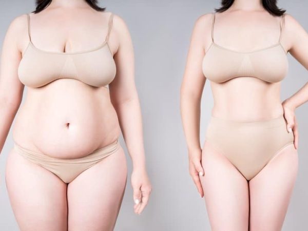 Lipedema Surgery Before and After Results and Recovery Guide
