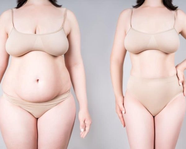 Lipedema Surgery Before and After Results and Recovery Guide