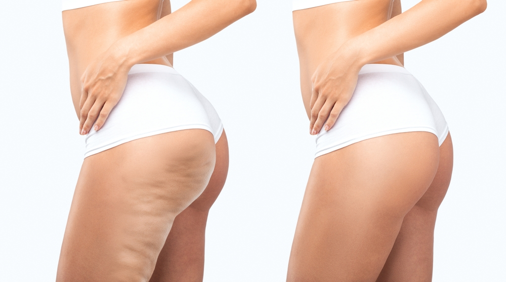 Lipedema Liposuction Cost Breakdown | What You Need to Know in 2026