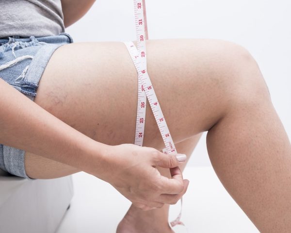 Best Exercises for Lipedema Legs: Low-Impact, Aquatic, and Strength Training Routine