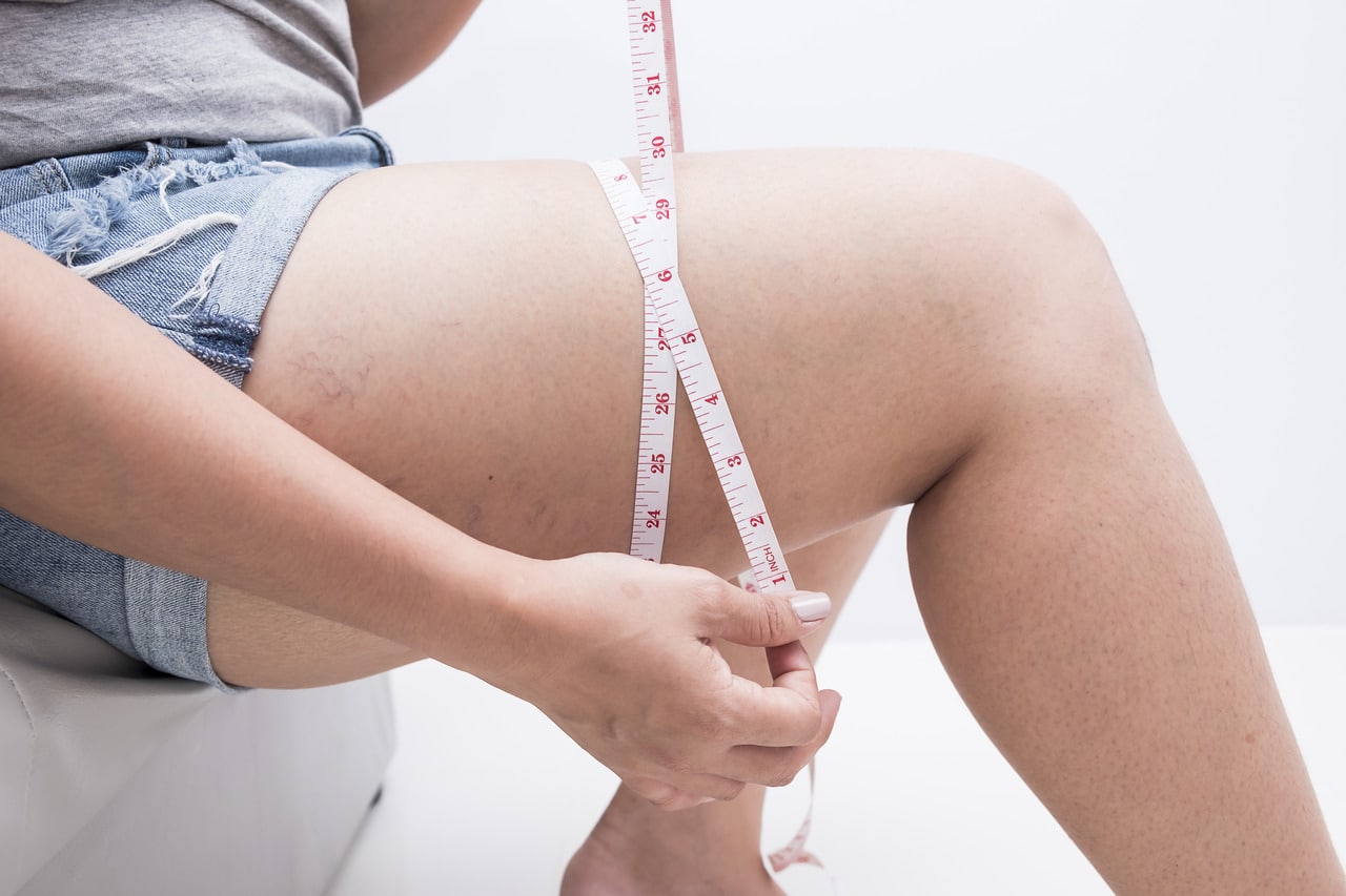 Why Lipedema Treatment Costs Vary: Procedures, Patient Factors & Care