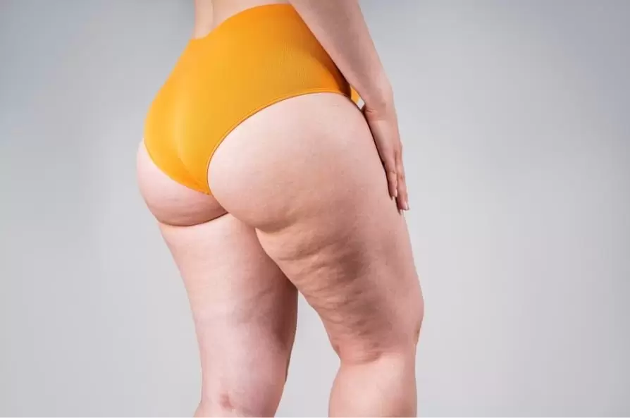 Best Compression Garments After Lipedema Surgery