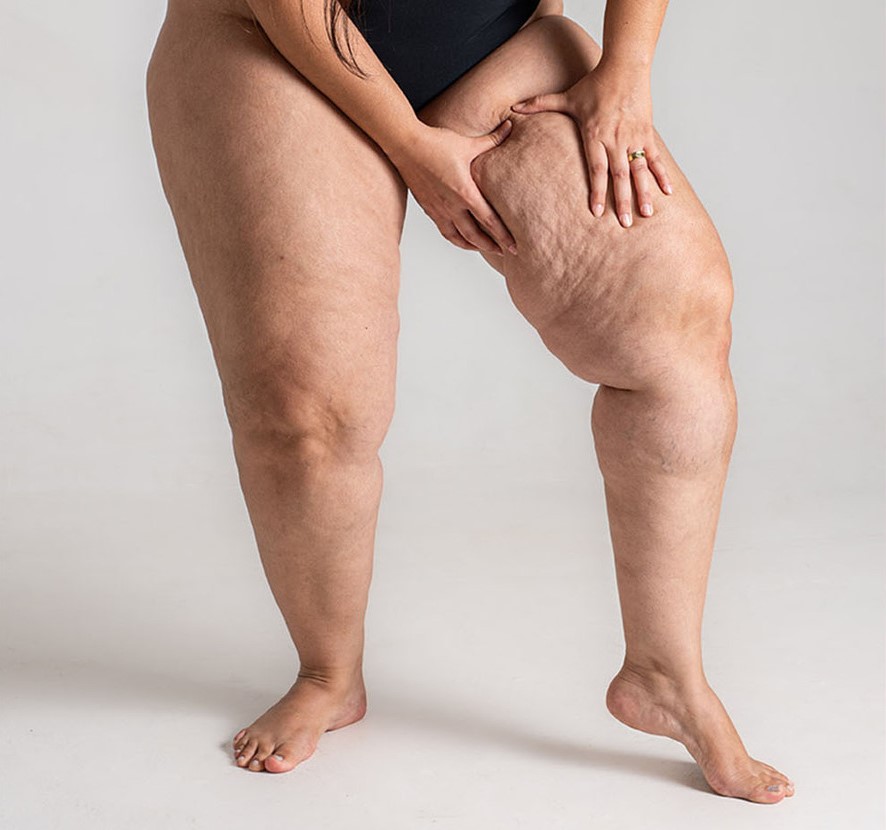 Living on a Boat with Lipedema: Challenges, Solutions & Support
