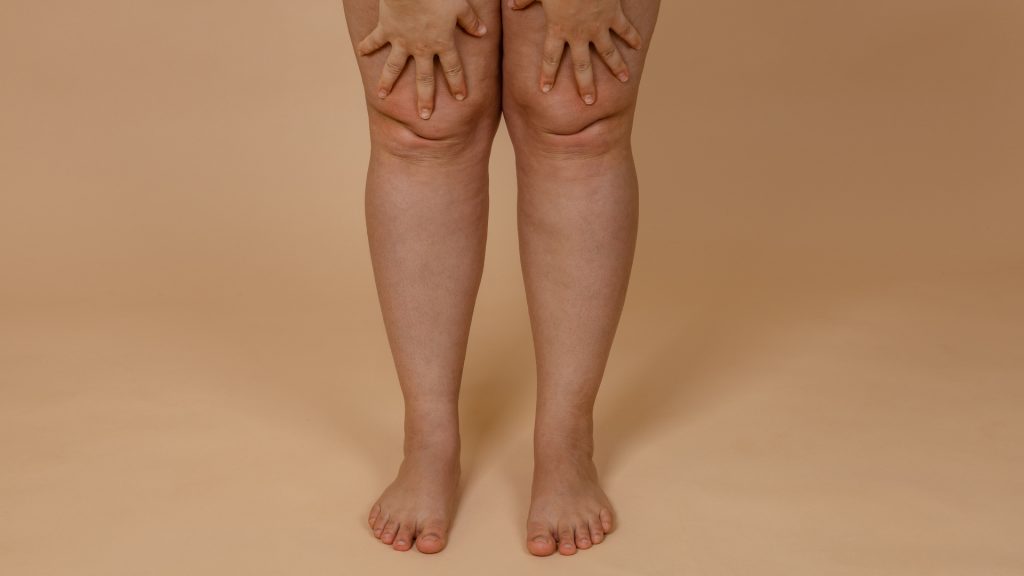 Lipedema Swelling Relief: Practical Tips, Causes & Treatment