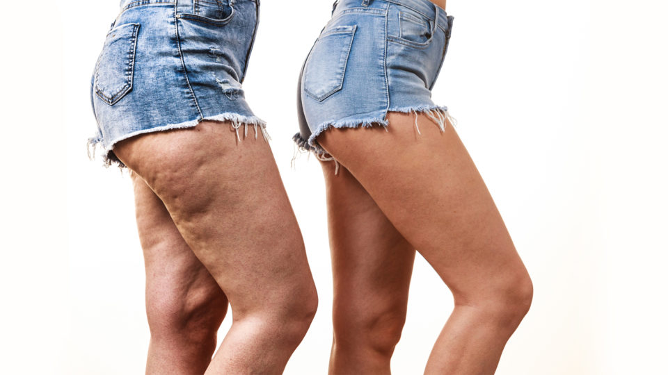 Water-Assisted Liposuction vs Tumescent Liposuction Outcomes for Lipoedema