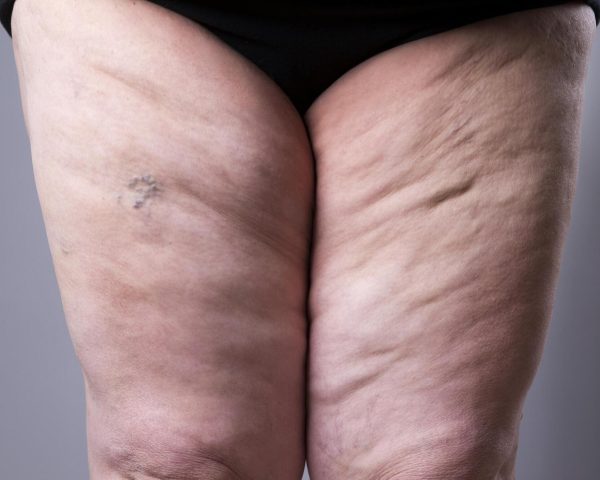 Stage 3 Lipedema: Definition, Symptoms & Treatment Options