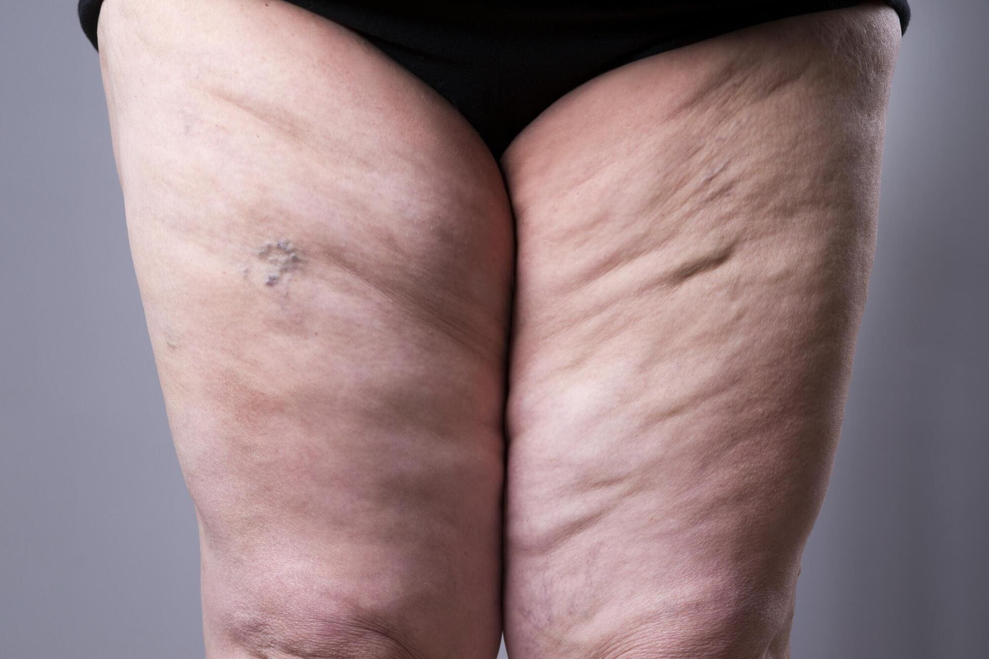 Stage 3 Lipedema: Definition, Symptoms & Treatment Options