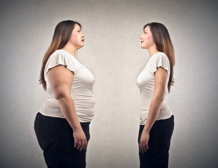 Why BMI Misclassifies Early Lipoedema Patients and Its Implications for Health