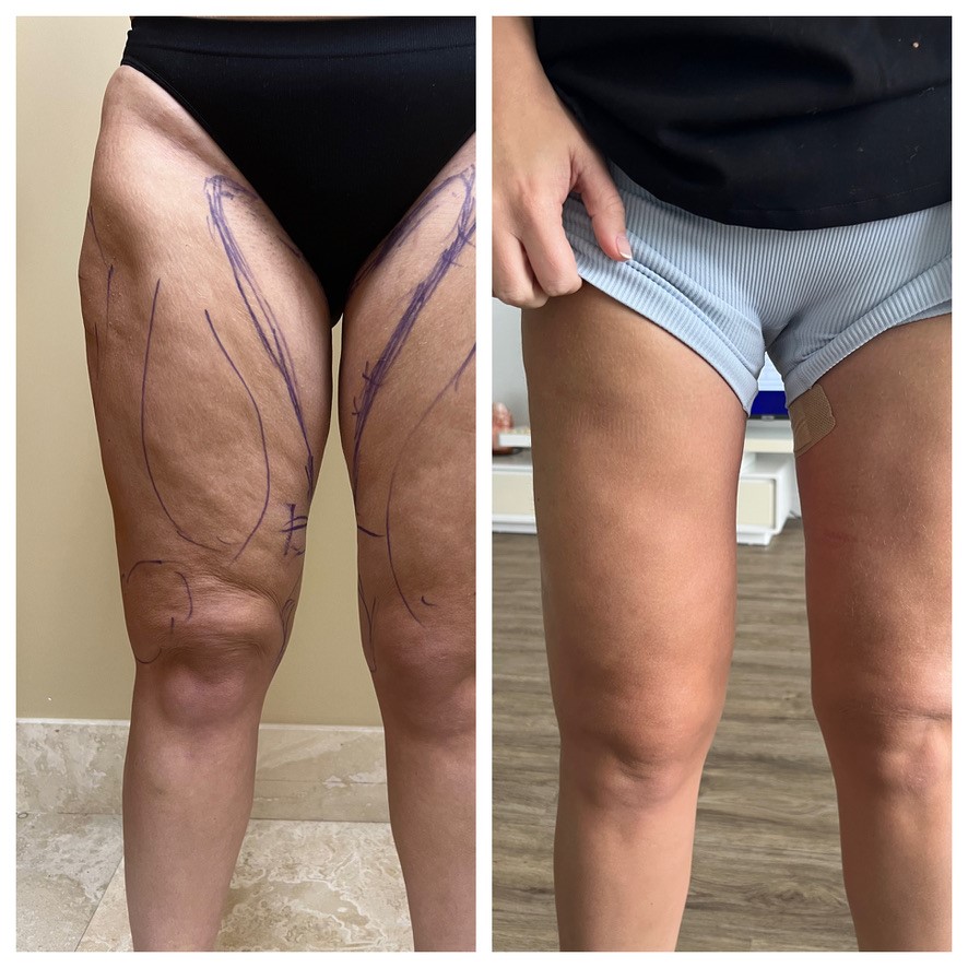 How To Prevent Silicone Bands From Rolling Down On Thigh Garments