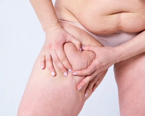 Management of Stage 4 Lipolymphedema: Comprehensive Approaches and Individualized Care