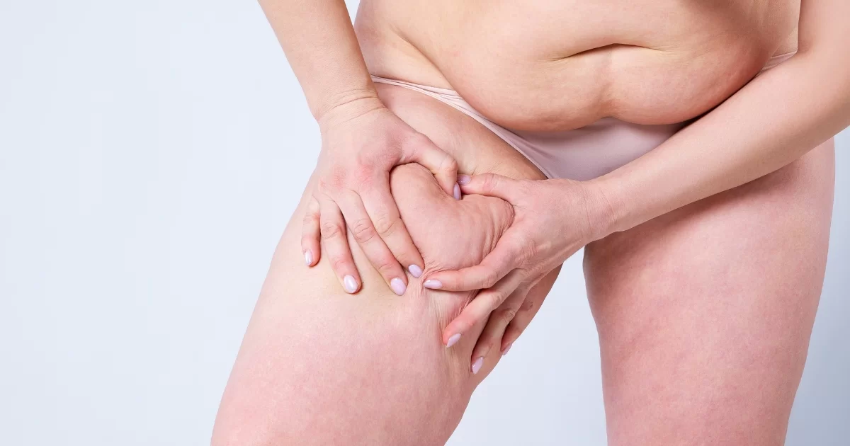 Management of Stage 4 Lipolymphedema: Comprehensive Approaches and Individualized Care