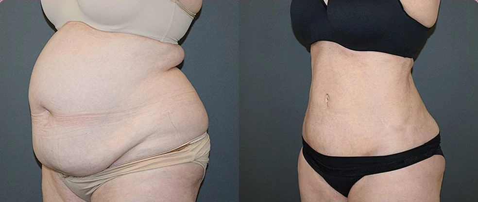 Recognizing Pediatric Lipedema: Signs and Symptoms in Teenage Girls