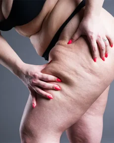 Foods That Reduce Lipedema Swelling: What to Eat, Avoid, and Lifestyle Tips