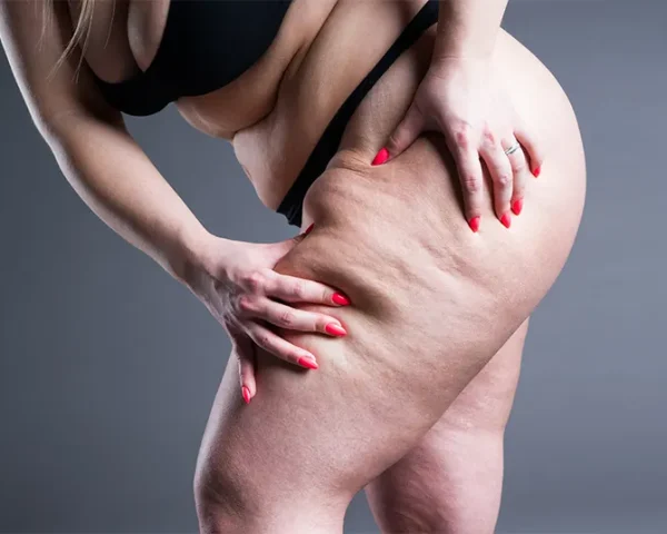 Foods That Reduce Lipedema Swelling: What to Eat, Avoid, and Lifestyle Tips