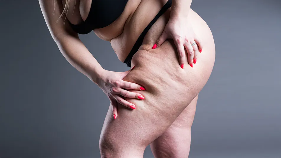 Lipedema Awareness Month Events and Resources 2026