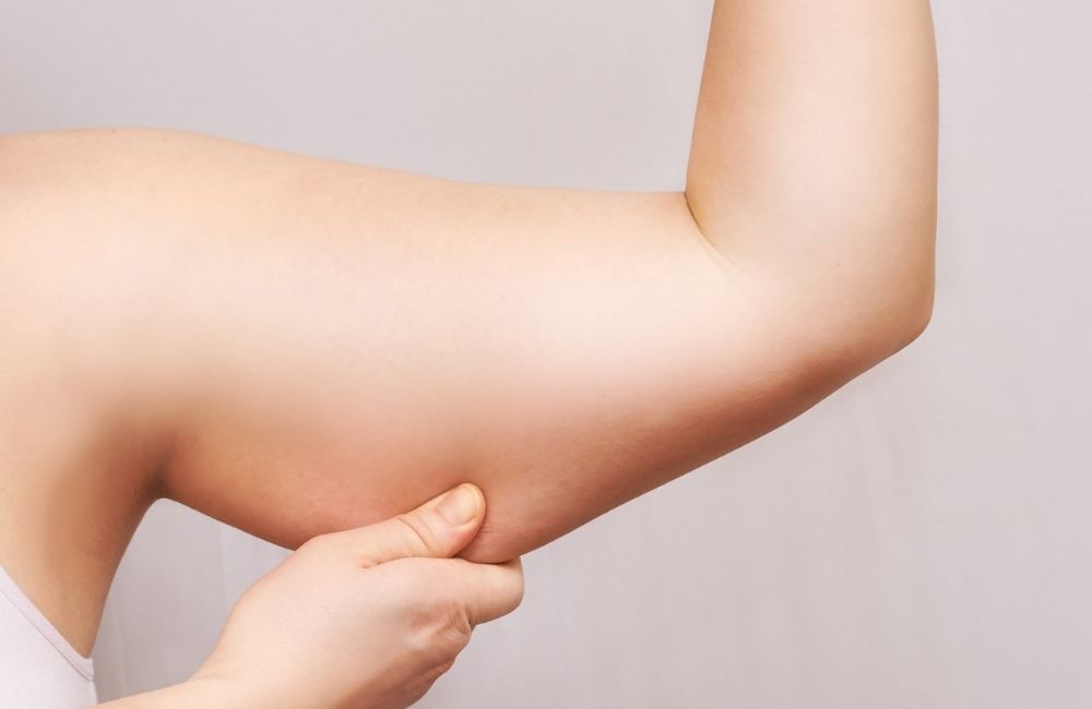 Lipedema in the Arms: Symptoms, Stages, and Treatment Options