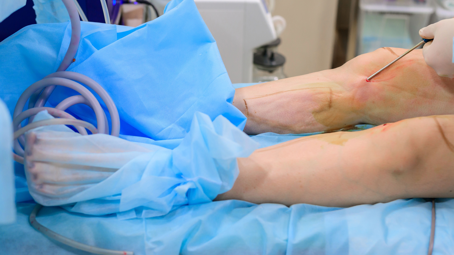 Lipedema Liposuction Complications: What You Need to Know
