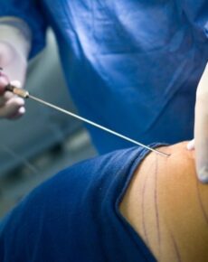 Is Lipedema Surgery Worth It? Cost, Risks, and Patient Outcomes