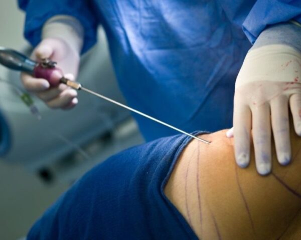 Is Lipedema Surgery Worth It? Cost, Risks, and Patient Outcomes