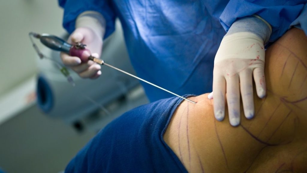 Lipedema Liposuction Scars: How to Care for and Minimize Them