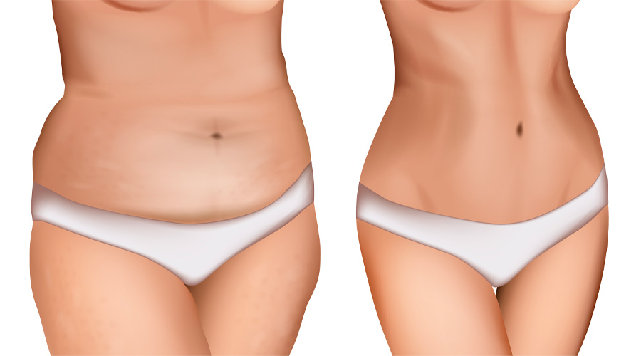 Numbness After Lipedema Surgery: Recovery Timeline and Management Tips