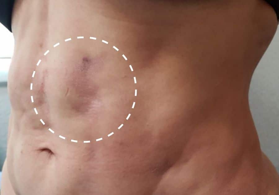 Fibrosis After Lipedema Liposuction: Symptoms, Treatment, and Prevention
