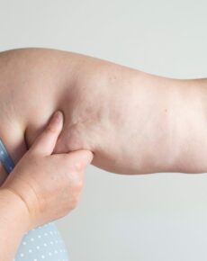 What is Arm Lipedema and How Does it Affect Quality of Life?
