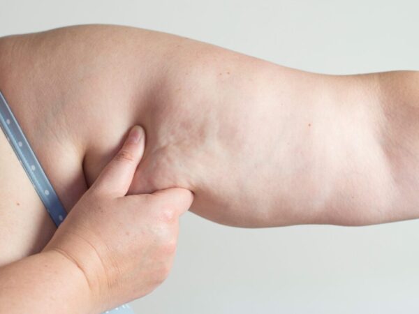 What is Arm Lipedema and How Does it Affect Quality of Life?