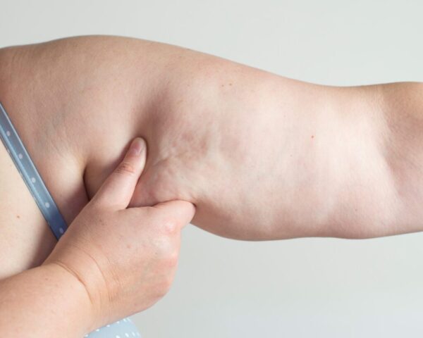 What is Arm Lipedema and How Does it Affect Quality of Life?