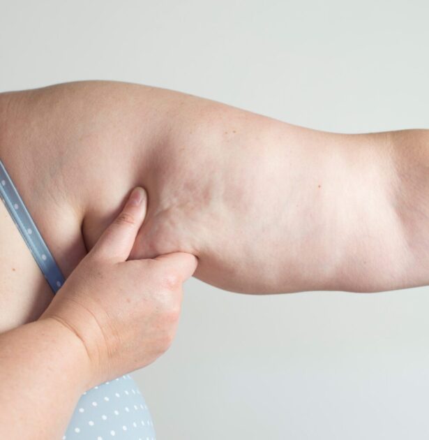 What is Arm Lipedema and How Does it Affect Quality of Life?