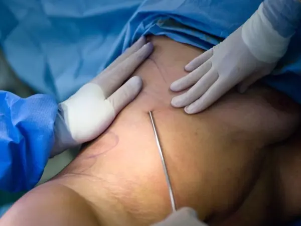 Can Lipedema Return After Surgery and How Can Multi-Stage Care Help Prevent It?