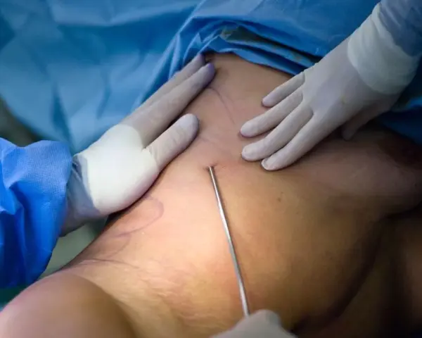 Can Lipedema Return After Surgery and How Can Multi-Stage Care Help Prevent It?