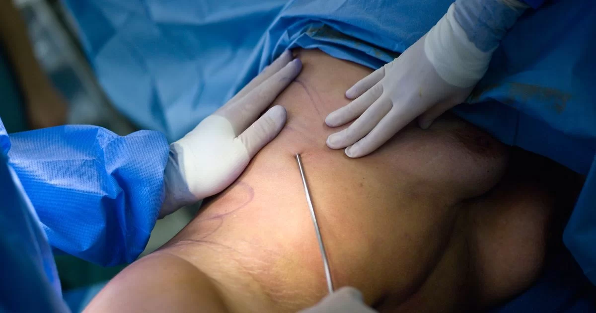 Can Lipedema Return After Surgery and How Can Multi-Stage Care Help Prevent It?
