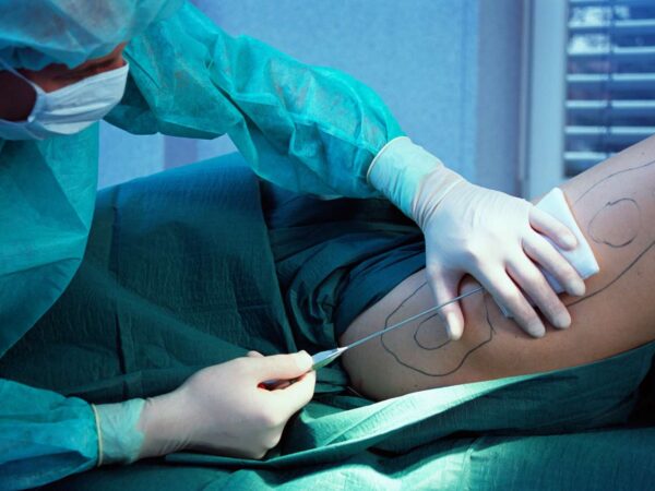 Is Lipedema Surgery Worth It?