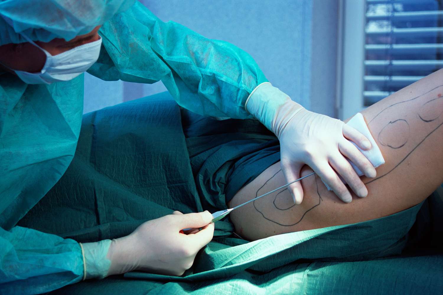 Is Lipedema Surgery Worth It?